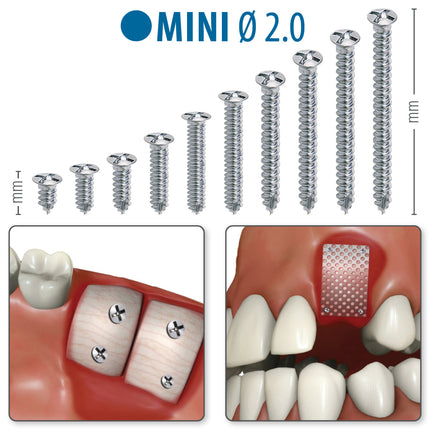 MINI Ø2.0 - Titanium Screws
