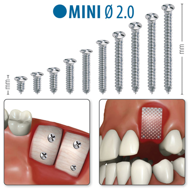 MINI Ø2.0 - Titanium Screws