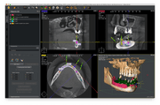 QUICKVISION 3D – Dental Implant Planning Software