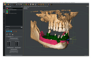 QUICKVISION 3D – Dental Implant Planning Software