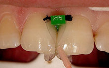 Dental Kit of Transparent Contoured Matrices Matrix Bands 120 pcs. TOR VM