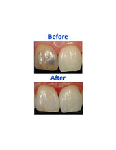 Unilite Endo Endodontic Non Vital Bleaching Whitening Paste 1.5g